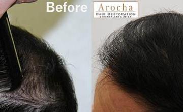 Hair transplantation surgery before and after pictures