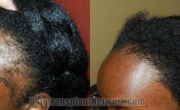 Female hair transplantation surgery before and after photos