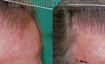 Comparison of left side before and after hair transplant