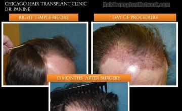 Hair restoration procedure before and after results