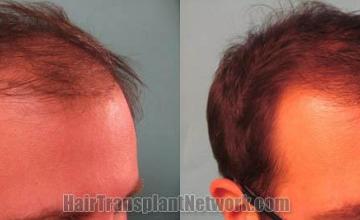 Hair restoration procedure before and after results