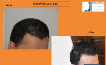 Hair transplantation surgery before and after photos