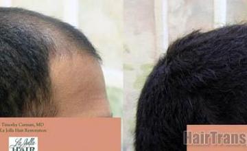 Hair transplantation surgery before and after images