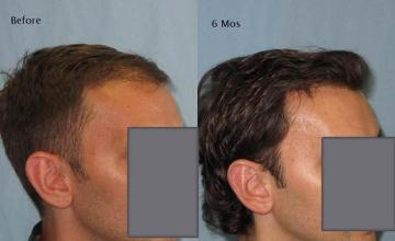 Hair transplantation surgery before and after photos