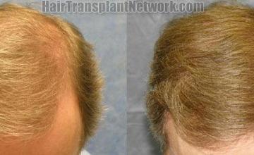 Top view photos before and after hair restoration procedure