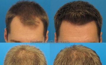 Hair restoration procedure before and after results