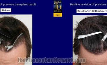 Hair restoration procedure before and after results