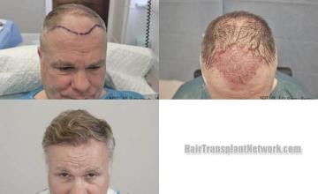 Hair restoration procedure before and after results