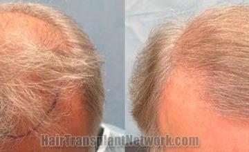  before and after photos