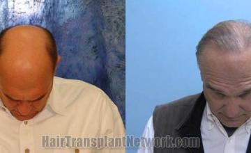 Hair transplantation surgery before and after pictures
