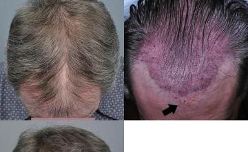 Hair transplantation surgery before and after images