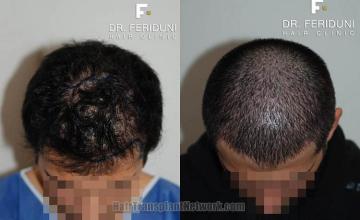 Top view before and after hair restoration results