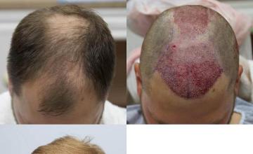 Hair transplantation surgery before and after photos