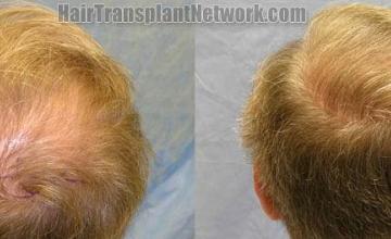 Back / Crown pictures before and after hair transplant