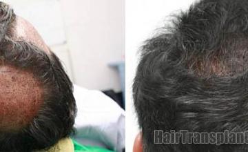 Back view before and after hair restoration images