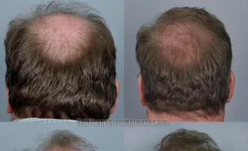 Hair restoration procedure before and after pictures