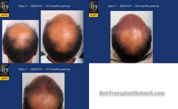 Back view before and after hair transplantation photos