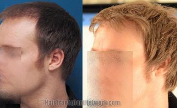 Hair transplantation surgery before and after pictures