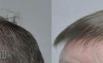 Hair transplantation surgery before and after photos