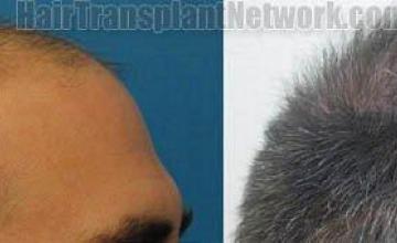 Right view photos showing hair transplant results