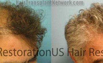 Right view - Hair replacement procedure photos