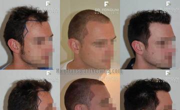 Hair restoration procedure before and after results