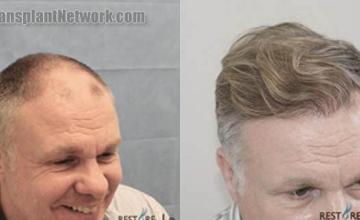 Hair transplantation surgery before and after photos