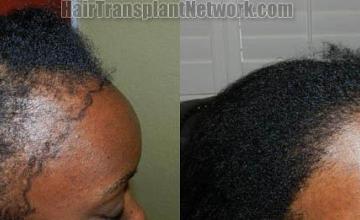 Female  before and after images