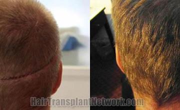 Hair restoration procedure before and after pictures