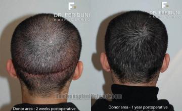 Hair transplant surgery before and after images