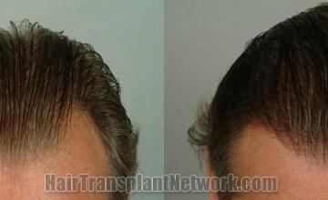 Before and after hair transplantation result photographs