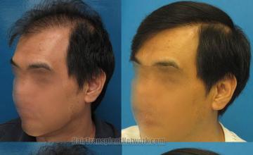 Hair transplantation surgery before and after photos