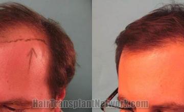 Hair transplantation surgery before and after photos