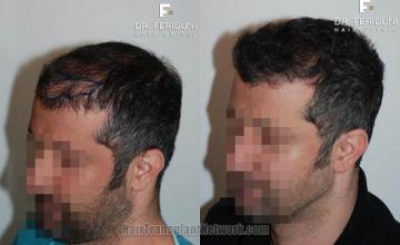 Hair transplantation surgery before and after pictures