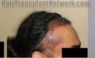 Hair restoration procedure results