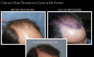 Hair transplantation surgery before and after images