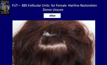 Hair restoration procedure before and after pictures