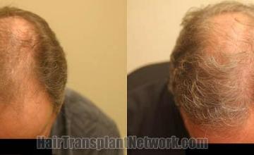 Hair transplantation surgery before and after photos