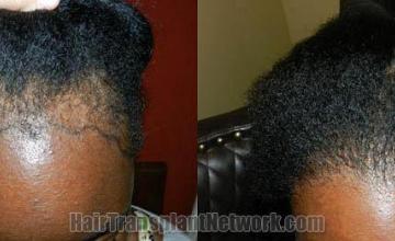 Female - top view before and after hair restoration results