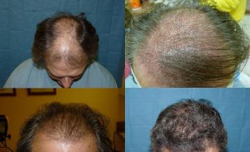 Before and after  pictures