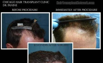 Hair restoration procedure before and after results