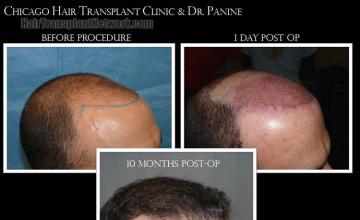 Hair transplantation surgery before and after photos