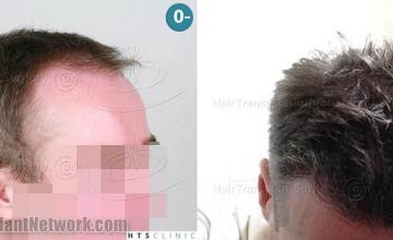 Hair transplantation surgery before and after images