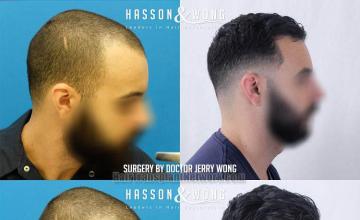 Hair transplantation procedure before and after results