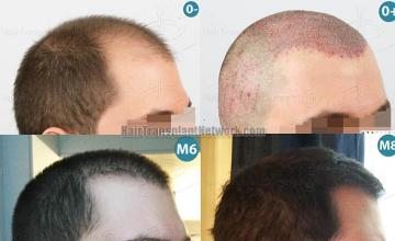  before and after photos