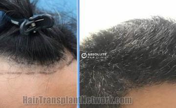 Hair transplantation procedure before and after results