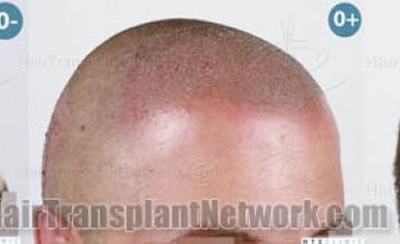  before and after photos