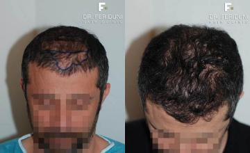 Hair restoration procedure before and after pictures