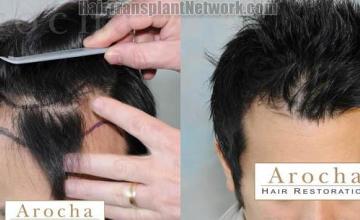 Top view before and after hair restoration results