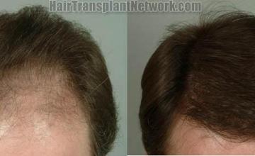 Top view - Before and after surgical hair replacement